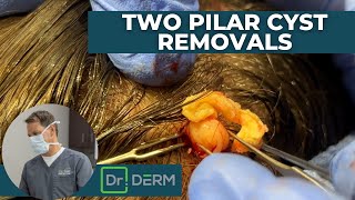 Two Pilar Cyst Removals  Dr Derm [upl. by Buyer59]