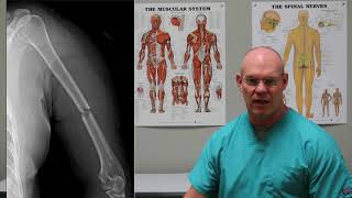 MidShaft Humerus Fracture  Episode 30 [upl. by Chipman464]