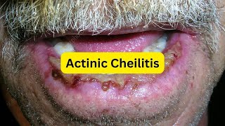 What is actinic cheilitis EASY [upl. by Bertila545]