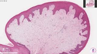 Fibroepithelial Polyp [upl. by Ynittirb68]