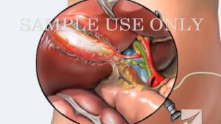 Gallbladder Removal Surgery Laparoscopic Cholecystectomy [upl. by Laufer]