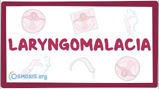 Laryngomalacia  an Osmosis Preview [upl. by Lama]