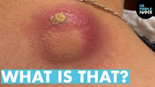 WHAT IS THAT Dr Lee Pops Satisfying Back Cyst  Dr Pimple Popper Reacts [upl. by Gnni]