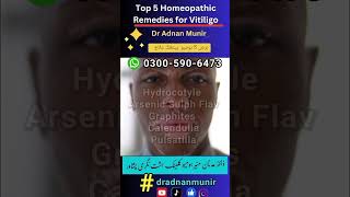 Best Homeopathic Treatment for Vitiligodradnan leucoderma skincare vitligo oladoc [upl. by Wilt867]