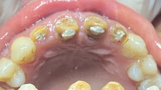 REMOVING A TOOTH AND THEN PUTTING IT BACK INTENTIONAL REIMPLANTATION [upl. by Kilan]