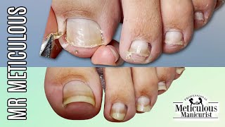 IMPACTED TOENAIL Gunk Removal on Mr Meticulous [upl. by Lady]