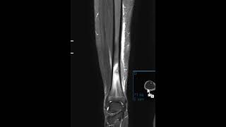 Osteomyelitis of tibia with follow up [upl. by Atneciv839]