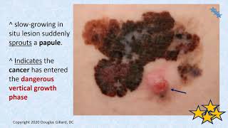 Malignant Melanoma The Most Deadly Form of Skin Cancer Primary Health Care Providers Cant Miss It [upl. by Toy]