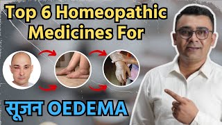 Top 6 Homeopathic Medicines for Oedema  Swelling on Body [upl. by Virgy]