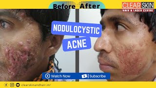 Severe Nodulocystic acne treatment  How To Get Rid of Nodular and Cystic Acne  DrNKailash [upl. by Tnecnev]