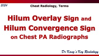 Hilum overlay sign and Hilum convergence sign [upl. by Ahsini655]