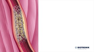 Angioplastie et pose de stent  Animation médicale [upl. by Suzi]