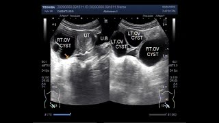 Ultrasound Video showing multiple Ovarian Cysts [upl. by Kanya]