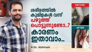 Bullous Eruptions on Skin benign Pemphigus Hailey Hailey Disease Malayalam  Dr Abhiram VK [upl. by Whitelaw]