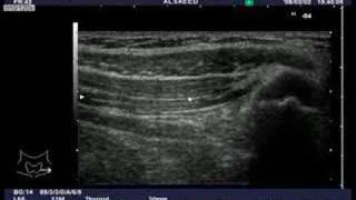 Ultrasound guided IlioinguinalIliohypogastric nerve block [upl. by Roselba568]