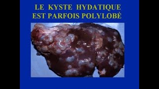 KYSTE HYDATIQUE DU FOIE [upl. by Humfrid]