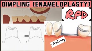 DIMPLING ENAMELOPLASTY II PROSTHETIC MOUTH PREPARATION II REMOVABLE PARTIAL DENTURE I PROSTHODONTICS [upl. by Saleem642]