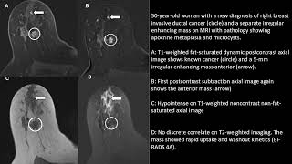 Fibrocystic Changes of the Breast Radiologic–Pathologic Correlation of MRI [upl. by Sedlik]