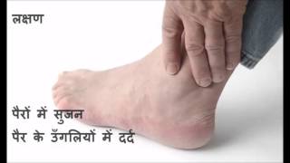 Find Uric Acid Treatment aur Ilaj in Hindi [upl. by Nnylasor]