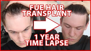 FUE Hair Transplant Timeline 1 YEAR  day 1365  12 Months Progress Before and After [upl. by Codd]