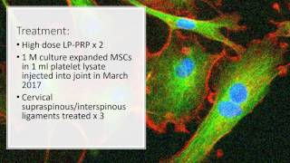 Dramatic Improvement In C2 C3 Facet Joint with Stem Cells [upl. by Azarcon]