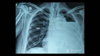 Hydropneumothorax Chest X Ray [upl. by Anala]