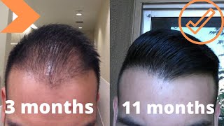 When To Expect Growth After A Hair Transplant My Timeline [upl. by Leah]