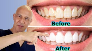 Whiten Your Teeth at Home the DIY Way  Dr Mandell [upl. by Hitt]