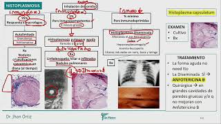 Infectología  Tipos de Micosis histoplasmosis aspergilosis broncopulmonar alergica aspergiloma aspe [upl. by Cornwell]