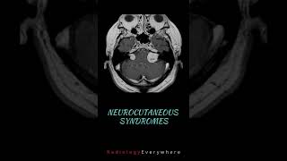 Neurocutaneous syndromes  Radiology tutorials  Radiology Everywhere [upl. by Ilrahc579]