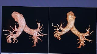 CT Pulmonary Angiography TOSHIBA AQUILION PRIME 160  Patient 54 Year In ICU [upl. by Onfroi]