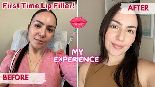 lip fillers  one year later [upl. by Eslek]