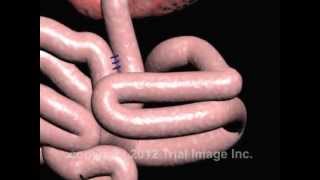 Intussusception of the Bowel video  Animation by Cal Shipley MD [upl. by Ide353]