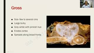 Osteochondroma Chondrosarcoma and Aneurysmal Bone cyst  Bone and Joints RATS in Pathology [upl. by Lenoyl]