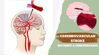 Cerebrovascular accident or stroke  Ischemic and hemorrhagic [upl. by Reedy]