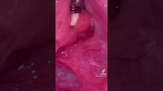 Removal of Tonsil stones [upl. by Erodaeht819]