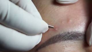 Acne Blackheads Whiteheads removals on face part 1 [upl. by Brader]