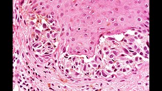 Atypical nevi Part 1 Neonatal nevi and nevus of specal sites Phillip H McKee [upl. by Amek]