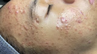 ACNE TREATMENT VU QUYNH MI  Perennial Blackheads On Boy Face 2024FULL [upl. by Omland190]