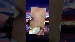 Blackheads Removal  Acne Treatment and Very Satisfying Satisfying Pimple pop blackheads [upl. by Cornelius]