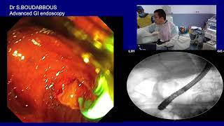 ERCP for acute cholangitis [upl. by French]