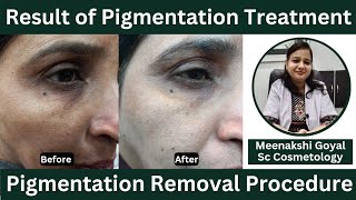 Result of Pigmentation Treatment  Pigmentation Removal Procedure [upl. by Yorker]