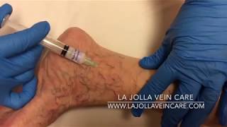 Vein Visionaries Highlighting the Best Sclerotherapy Videos of 2024 [upl. by Aysab251]