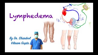 Lymphedema for MBBS MS Surgery medical students [upl. by Hong]