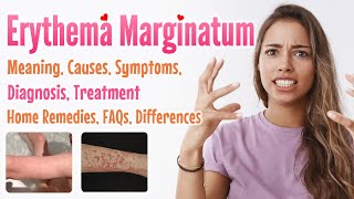 Erythema marginatum overview meaning signs and symptoms diagnosis treatment home remedies FAQs [upl. by Akema]