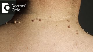 How do you get rid of skin tags naturally  Dr Madhu SM [upl. by Albin]