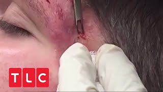 Zyste muss aus Gesicht entfernt werden  Dr Pimple Popper  TLC Deutschland [upl. by Aissilem]