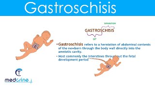 Gastroschisis Definition Causes and Diferences with Omphalocele [upl. by Annoyi]