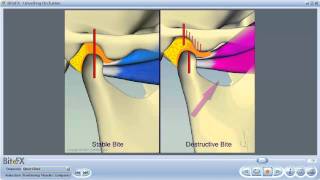 TMJ Disorders [upl. by Ettore]