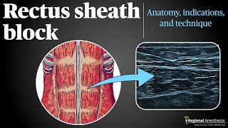 Rectus Sheath Block [upl. by Guglielma]